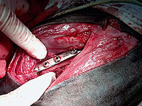 Zlomenina stehenn� kosti a jej� chirurgick� �e�en�